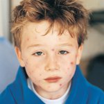 Molluscum contagiosum ในเด็ก Molluscum contagiosum ในเด็ก