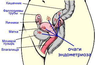 Endometriosis: การรักษาด้วยการเยียวยาพื้นบ้าน