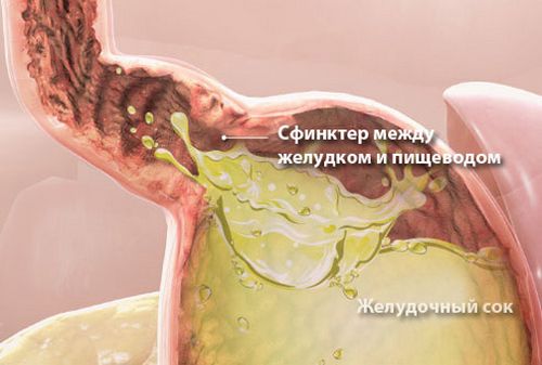 จะทำอย่างไรถ้าคุณมีอาการเสียดท้อง