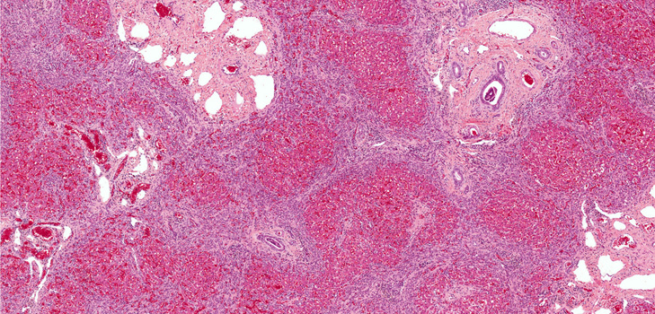 fibrosis คืออะไร? อาการรูปถ่ายการรักษา