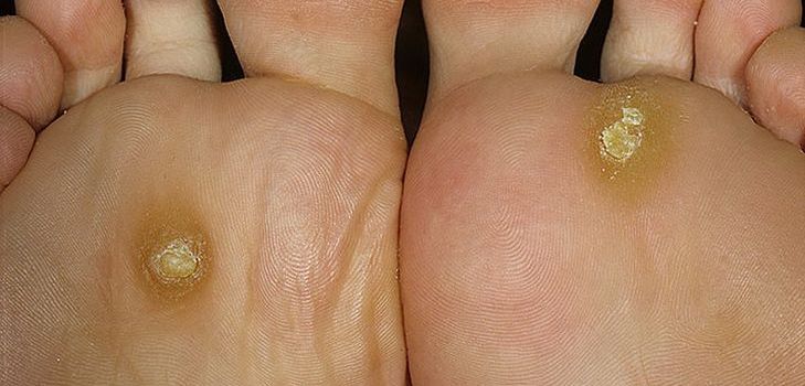 ปัญหาเกี่ยวกับ corns และ calluses? มองหาทางออกที่นี่!