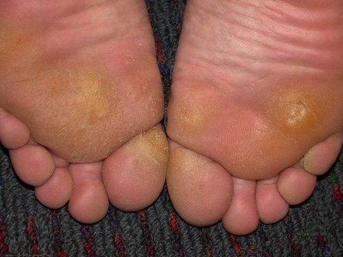 ปัญหาเกี่ยวกับ corns และ calluses? มองหาทางออกที่นี่!