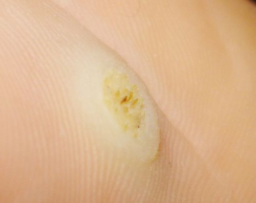 ปัญหาเกี่ยวกับ corns และ calluses? มองหาทางออกที่นี่!
