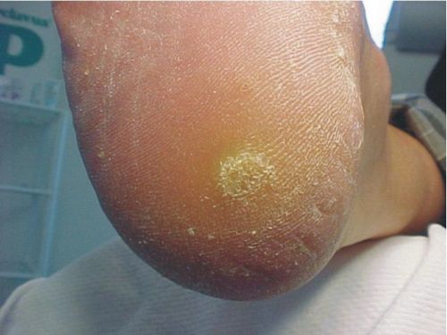 ปัญหาเกี่ยวกับ corns และ calluses? มองหาทางออกที่นี่!