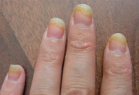 การเยียวยาที่ดีที่สุดสำหรับเชื้อราเล็บบนขาและมือ