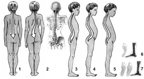 นวดด้วย scoliosis ในเด็ก