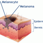 Melanoma ของผิว