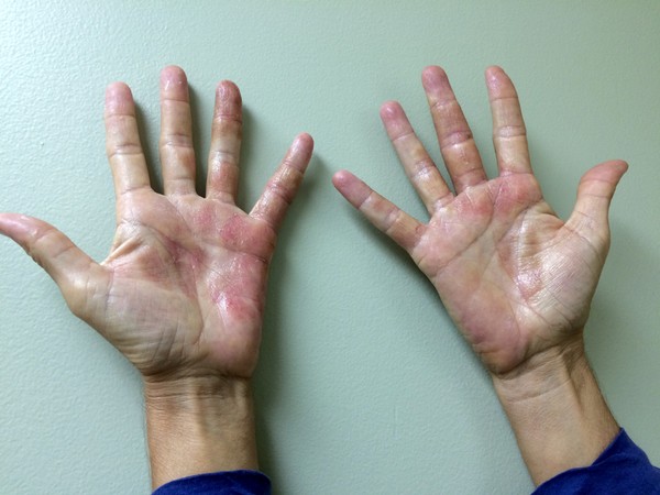 ฟองอากาศที่มีน้ำปรากฏบนฝ่ามือของคุณ: ต้องทำอย่างไร