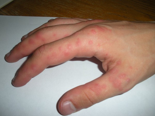 ฟองอากาศที่มีน้ำปรากฏบนฝ่ามือของคุณ: ต้องทำอย่างไร