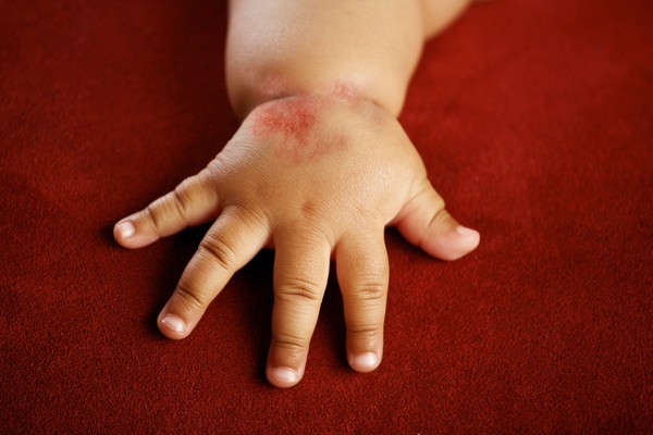 ฟองอากาศที่มีน้ำปรากฏบนฝ่ามือของคุณ: ต้องทำอย่างไร