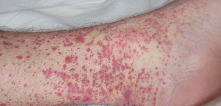 Vasculitis - มันคืออะไร? อาการรูปถ่ายการรักษา